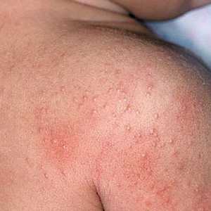 Alergija dysbacteriosis