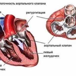 Aortne srčne bolezni: zdravljenje, simptomi, znaki, vzroki