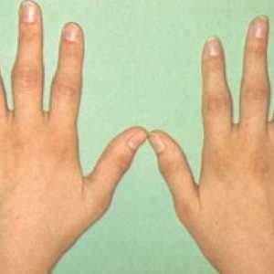 Artritis metakarpalnem falango skupno roke: zdravljenje, simptomi, znaki, vzroki