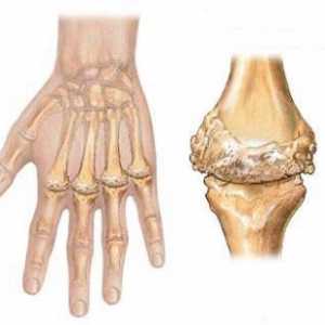 Vnetni artritis (infekcijska in infekciozne-alergijske)