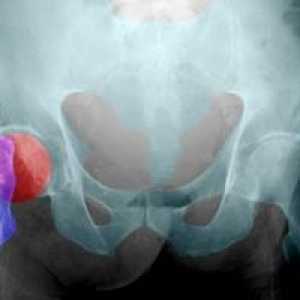 Aseptično nekrozo kosti: fazi zdravljenja, vzroki, simptomi, znaki
