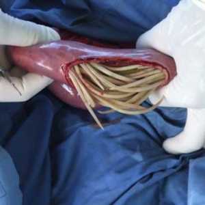Ascaris v črevesju, želodcu, tankem in debelem črevesu