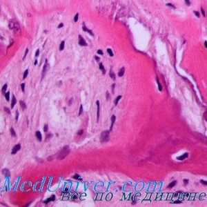 Ateroskleroza v ozadju inzulinsko rezistenco. Maščobe presnova v stanje diabetes in pre-diabetične