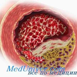 Ateroskleroza v menopavzi in menopavzi. Vpliv testosterona na arterioskleroze androgeni