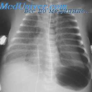 Barotravma pljuč med dekompresijo. Patogeneza barotravma pljuč