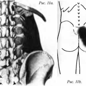 Bolečine v hrbtu je povzročil quadratus lumborum