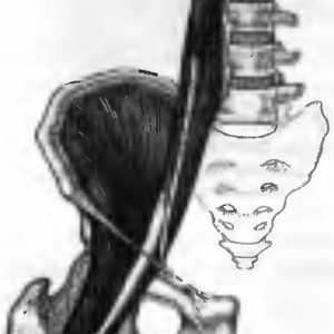 Bolečine v hrbtu, ki jih je mišična skupina iliopsoas mišice povzroča