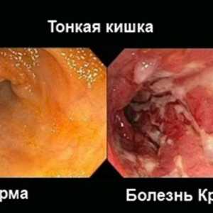 Crohnova bolezen in ulcerozni kolitis