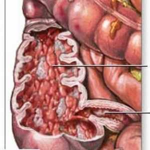 Bolezen tankega črevesja Crohnova