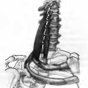Bolečine v hrbtu, ki so jih mišice scalene povzroča