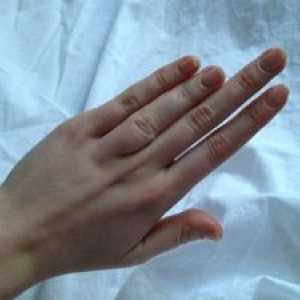 Brachydactyly palec: vzroki, zdravljenje, simptomi, znaki