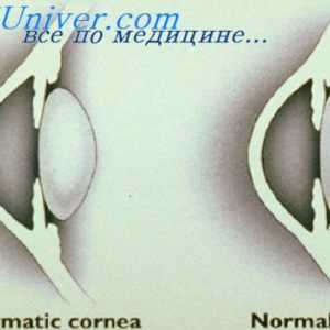 Ophthalmoscope. intraokularna tekočine