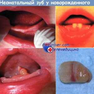 Neonatalne zob novorojene vzroki, diagnoza
