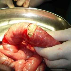 Da jedo črvi v človeškem telesu, in kako se razmnožujejo