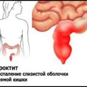 Kaj je proktitis črevesa?
