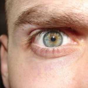 CMV retinitis: simptomi, zdravljenje, diagnoza, preprečevanje