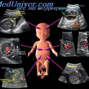 Color Doppler ultrazvok s molarne nosečnosti. Barva preslikavo plovila fetalnih