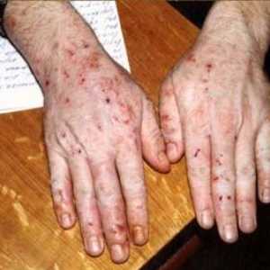 CYP vnetje trebušne slinavke, kožni izpuščaji trebušne slinavke bolezni