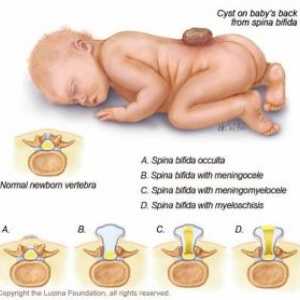Nevralne cevi pri otrocih: encefalokela, meningomyelocoele