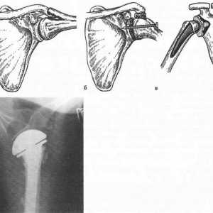 Deformiranja artroze sklepov zgornjega kraka