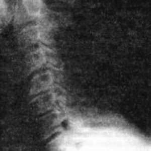 Degenerativni-distrofna bolezni spinalne osteohondroze, spondiloze in spondiloartroz