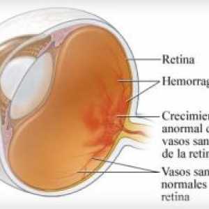 Nonproliferative diabetične retinopatije in diabetične retinopatije (npdr)