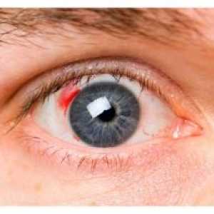 Diabetična retinopatija: simptomi, zdravljenje, oder, zapleti