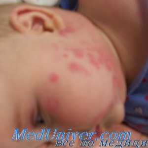 Diagnoza alergije in drugih stranskih učinkov zdravil pri otrocih