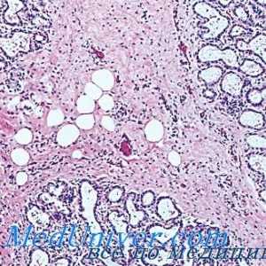 Gravesova bolezen (hipertiroidizem, tirotoksikoza, grevsa bolezen): patološka anatomija