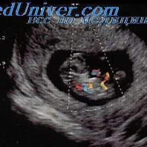 Dopplerjev ultrazvočni zarodka. Pretok Študija kri v fetalnih duktusa venosus