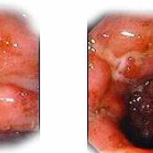 Oblike in faze Crohnovo boleznijo