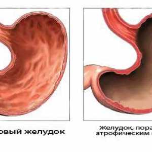 Gastritis in rak želodca