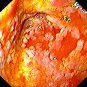 Gastritis z intestinalno metaplazijo