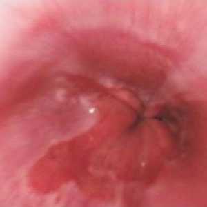 Gastroezofagealna refluksna bolezen: zdravljenje, simptomi, vzroki, simptomi