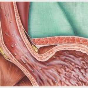 Gastroezofagealna refluksna bolezen: simptomi, zdravljenje, vzroki, simptomi