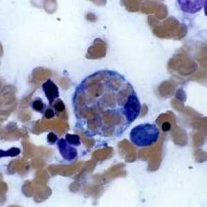 Hemophagocytic lymphohistiocytosis: zdravljenje, povzroča, prognozo