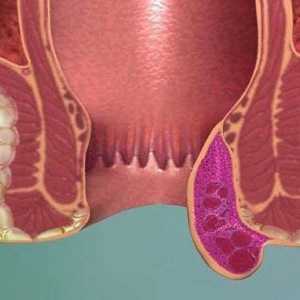 Hemorrhoidal tromboza: faza, simptomi in zdravljenje