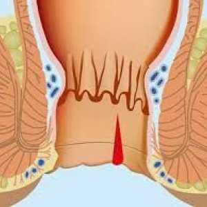 Hemoroidi in analna razpoka iz danke