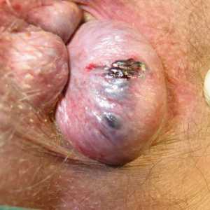 Hemoroidi in okužbe, zdravljenje infekcijskih bolezni