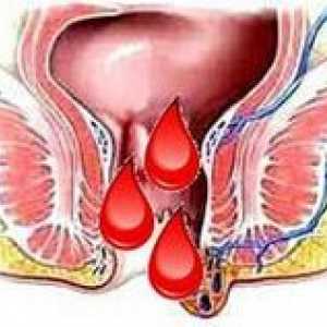 Hemoroidi med menstruacijo, zakaj se poslabša pred njimi?
