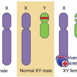Genetske motnje spolnih žlez. Geni sry, WT1 in sindromi Fraser in Denis-dresha