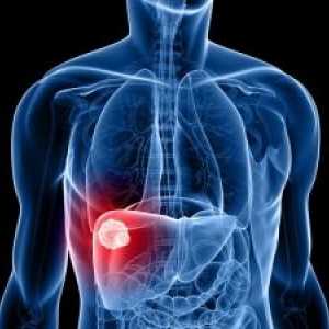 Hepatocelularni karcinom jeter: simptomi, zdravljenje, prognozo, diagnoza
