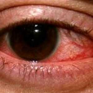 Herpetičnega vnetja roženice oči: zdravljenje, preprečevanje, simptomi, vzroki