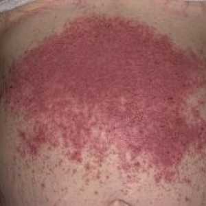 Dermatitis herpetiformis: simptomi, zdravljenje
