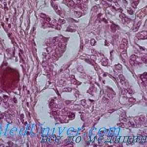 Hyperparathyroid generalizirana vlaknasti osteodistrofije (von Recklinghausen bolezni) morfologija,…