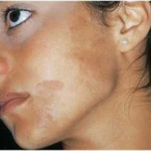 Hiperpigmentacija kože: zdravljenje, vzroki, preprečevanje