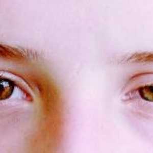 Očesni ishemični sindrom: simptomi, zdravljenje, klasifikacija, vzroki