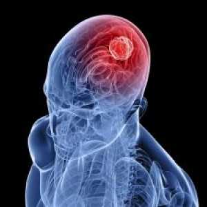 Možgani gliom: zdravljenje, prognoza, simptomi, znaki