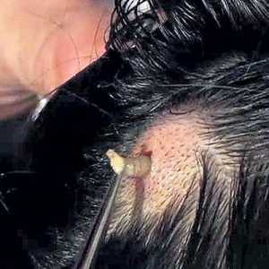 Moški simptomov črvi glava (podpiše) in zdravljenje