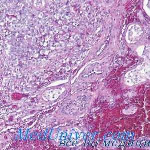 Gormonalnoaktivnye testisov tumorjev leydigomy